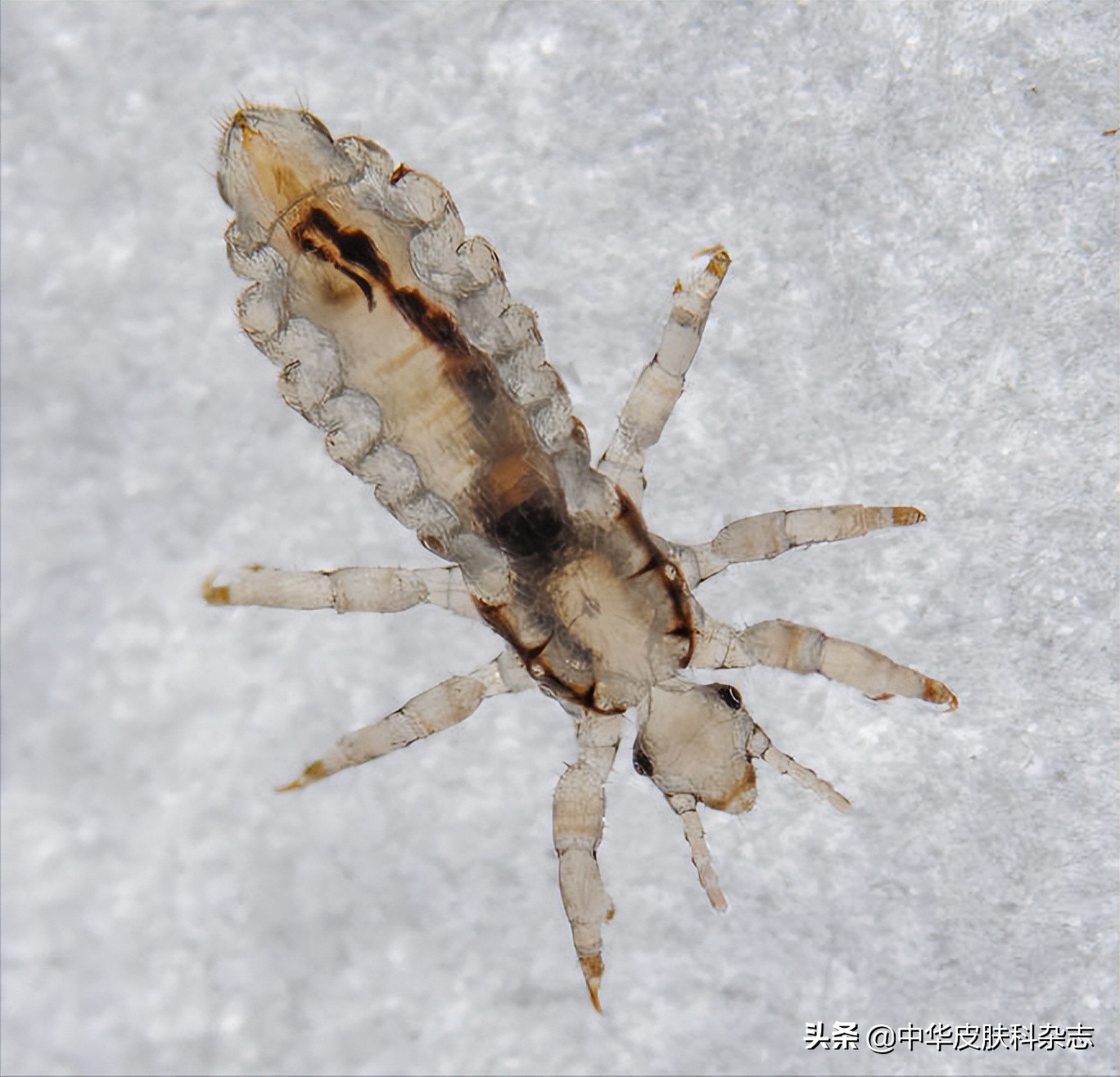 头上长虱子怎么治疗最好,头上长虱子是什么样的