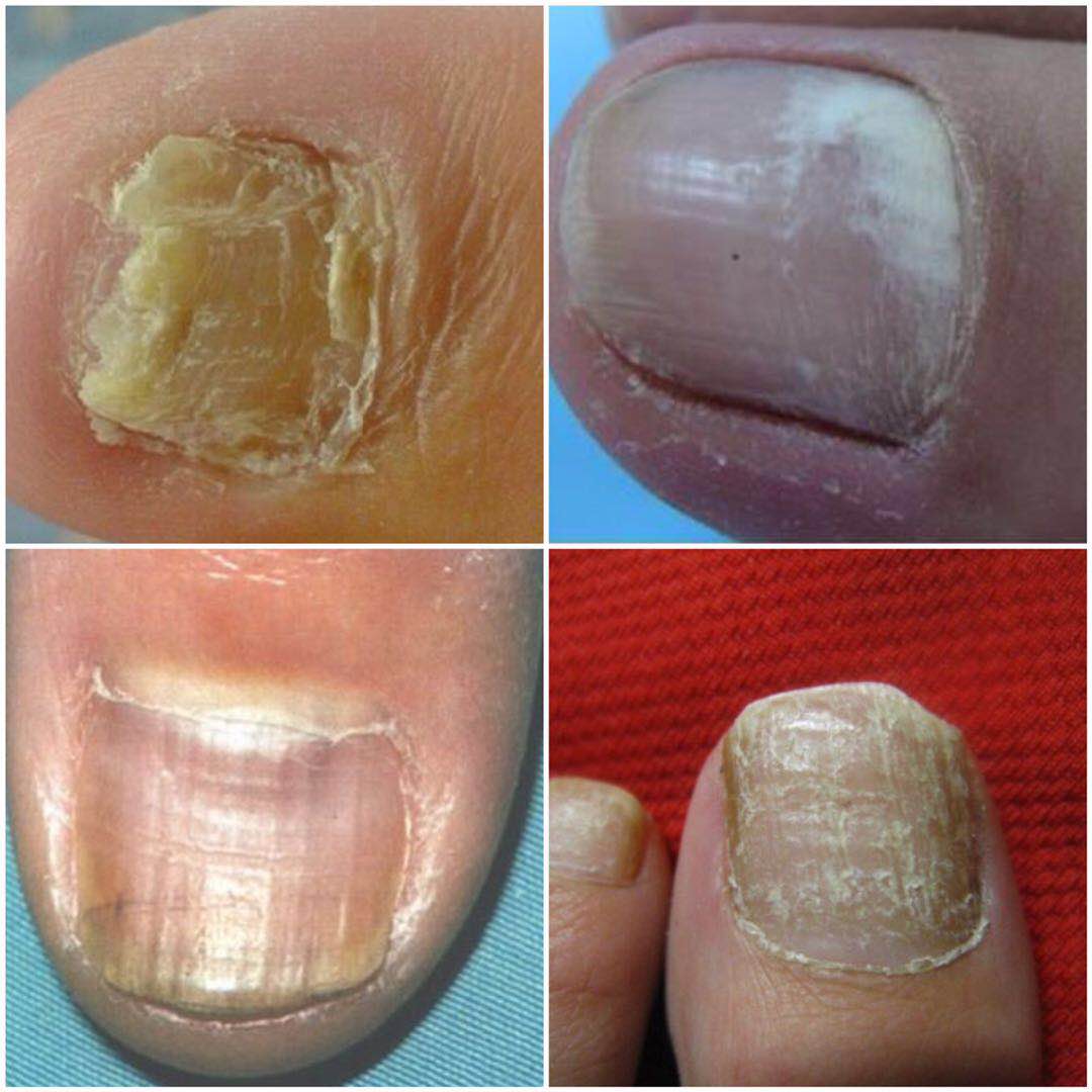 灰指甲接触的物品怎么处理,灰指甲周围皮肤都坏了如何处理