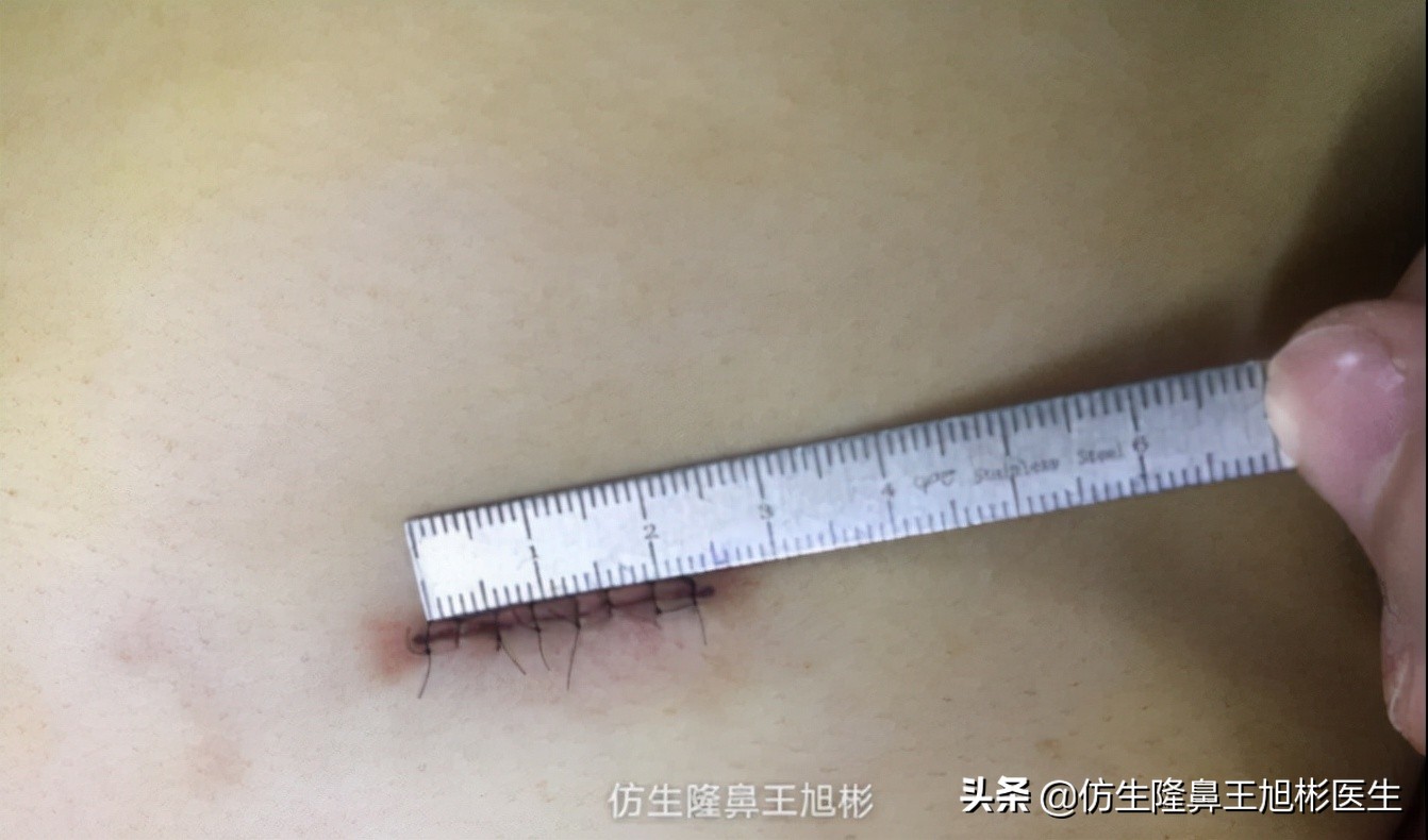 肋软骨的缺点与好处,科普什么是肋软骨鼻综合