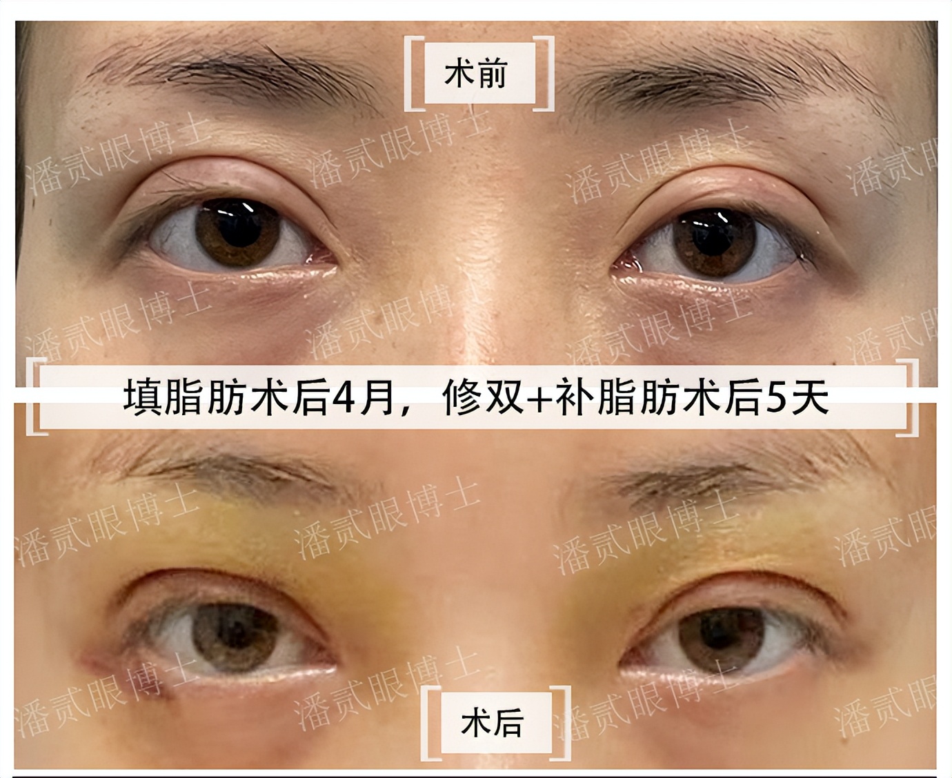 割双眼皮失败女的视频最新,割双眼皮失败女网红