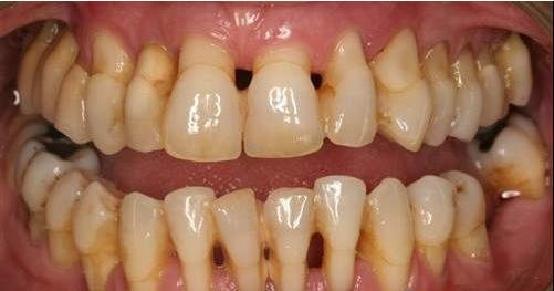 年纪大了牙齿变短是什么原因,年纪大了牙齿变长