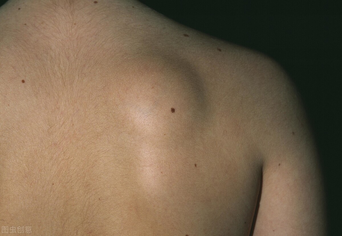 长了脂肪瘤怎么办中医有绝招,背上长个脂肪瘤老痒是瘤子在长吗