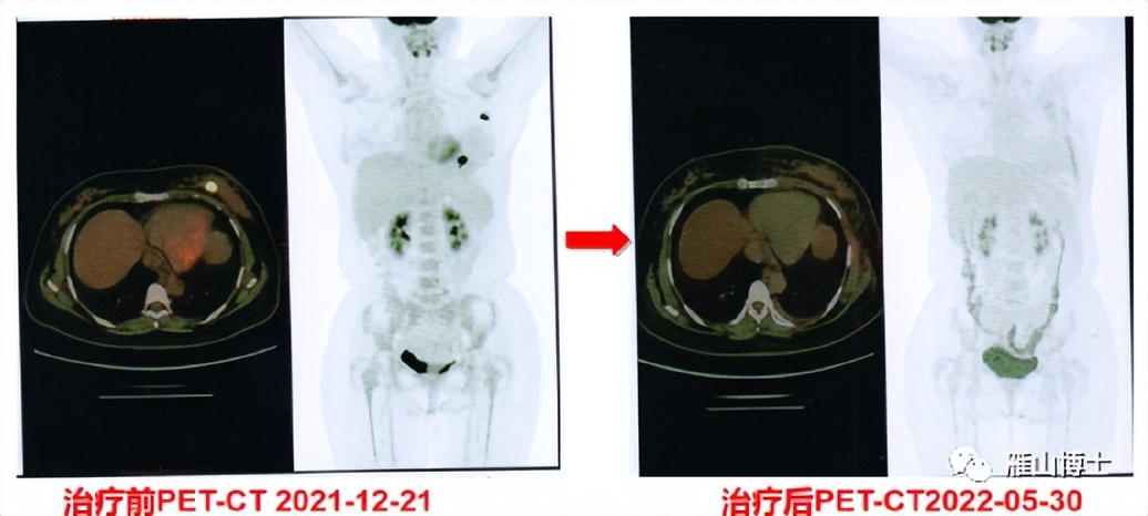 乳腺癌发现早可以用药物解决吗,面对乳腺癌的正确方法