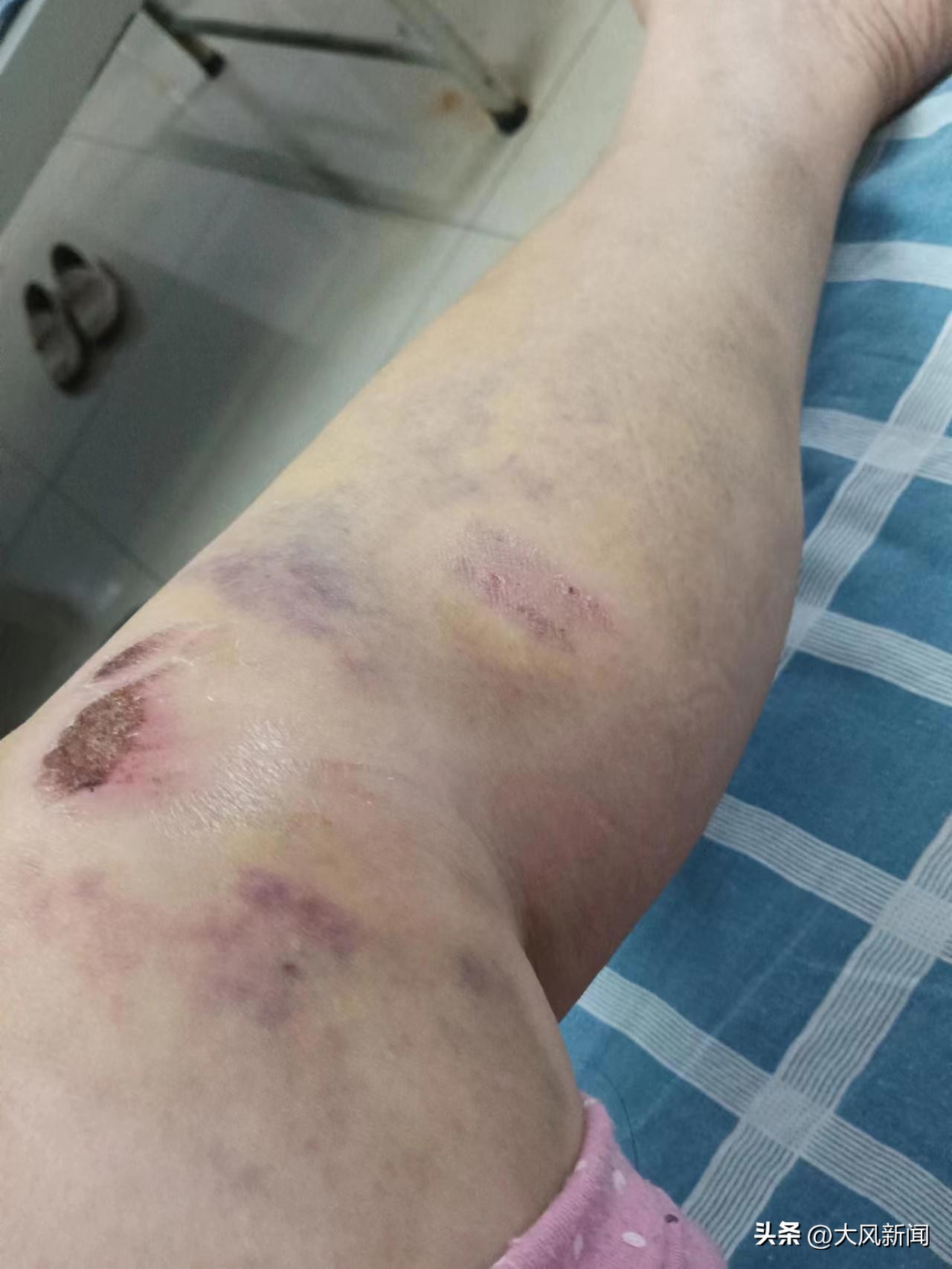 女员工被车撞伤后续,工厂内被同事叉车撞伤需要报警么