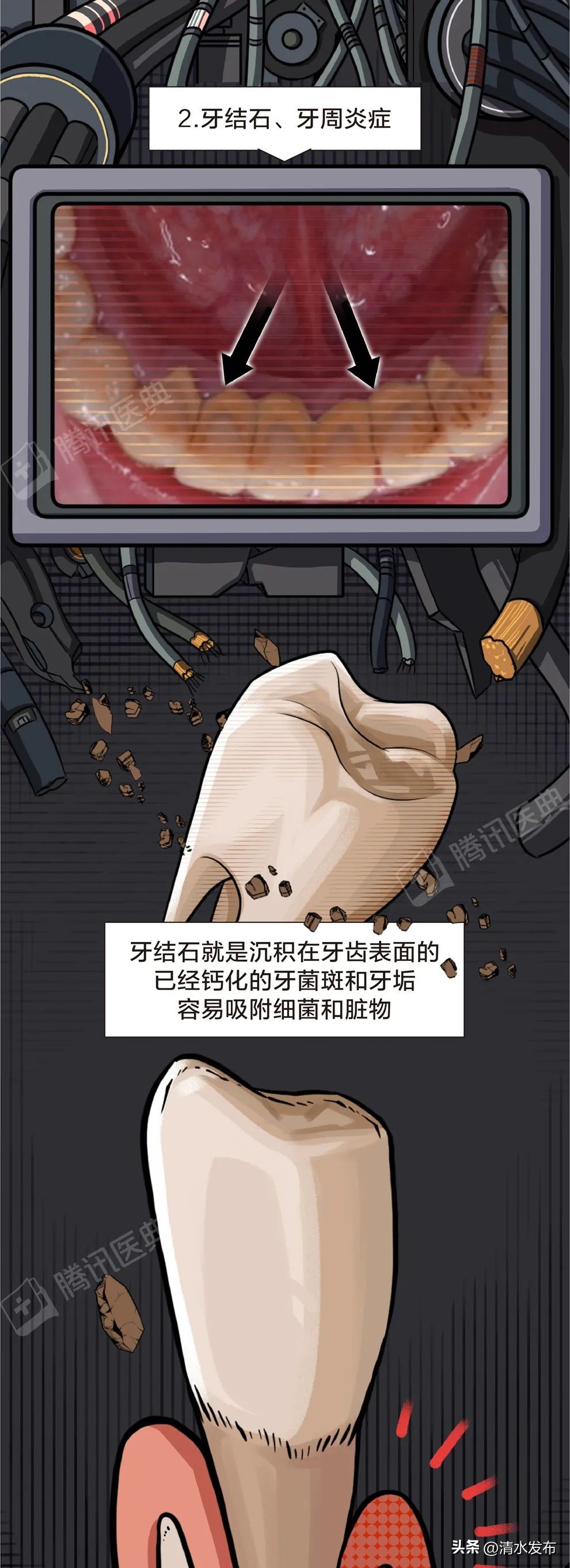 两边大牙一吃肉就塞牙如何修复,14岁学生吃肉老是塞牙需要矫正吗