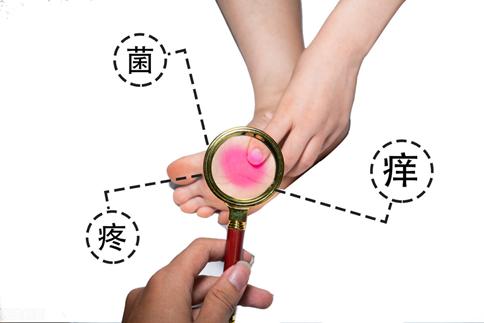 脚臭脚痒最佳治疗方法,脚藓脚臭用什么药膏