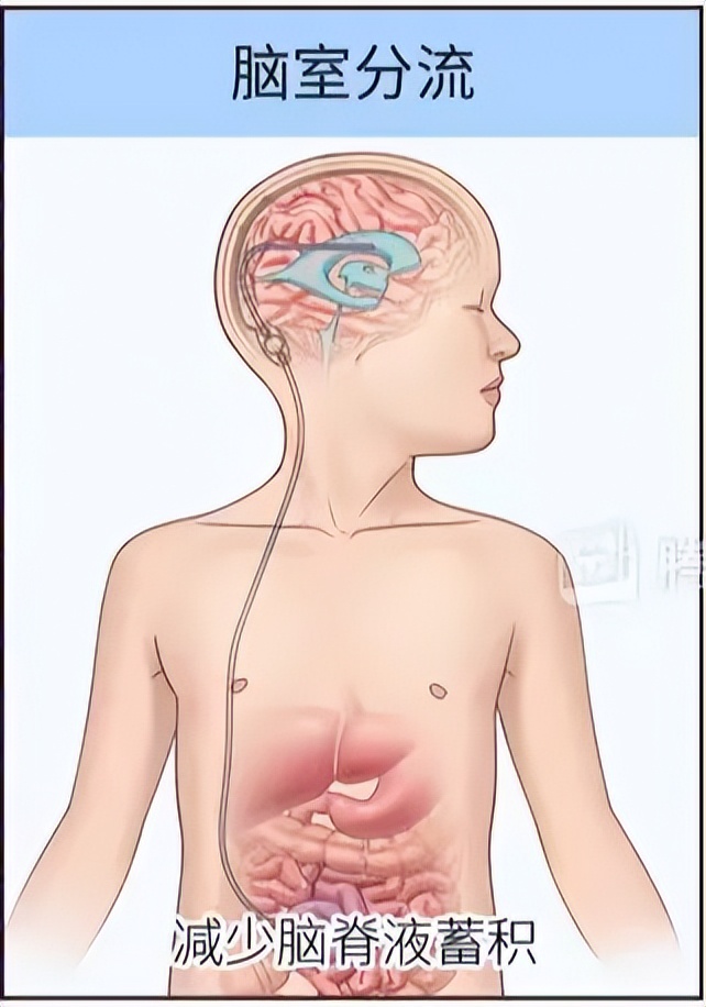 医生一转遥控器,我脑袋里的水就自动流进了肚子
