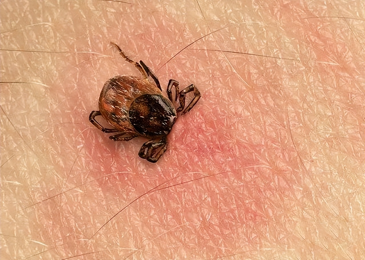 小孩被蜱虫咬了能活多久,孩子被蜱虫咬了三天