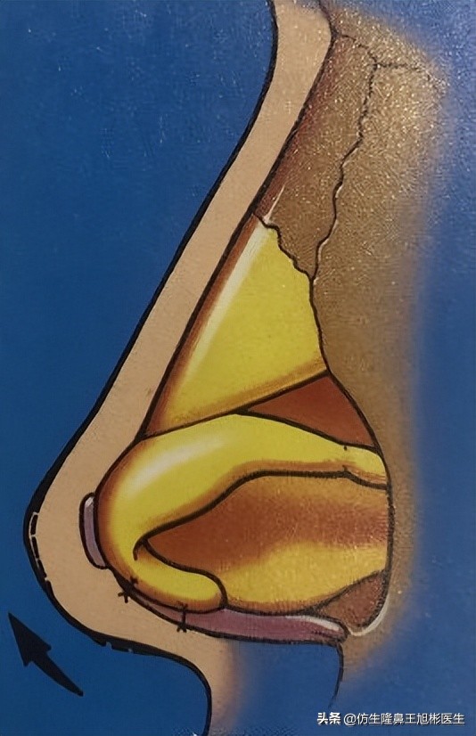 鼻头部位整形,鼻头圆钝高鼻梁整形案例