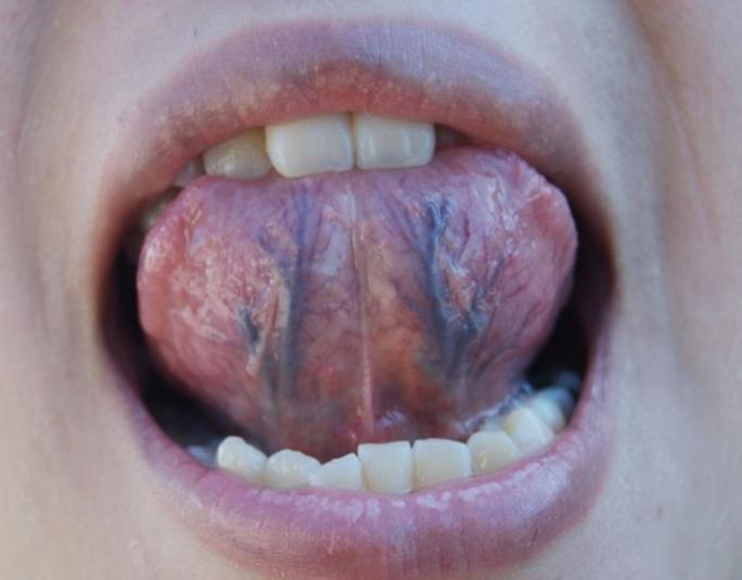 血虚血热血燥方剂,血虚血热血寒血瘀