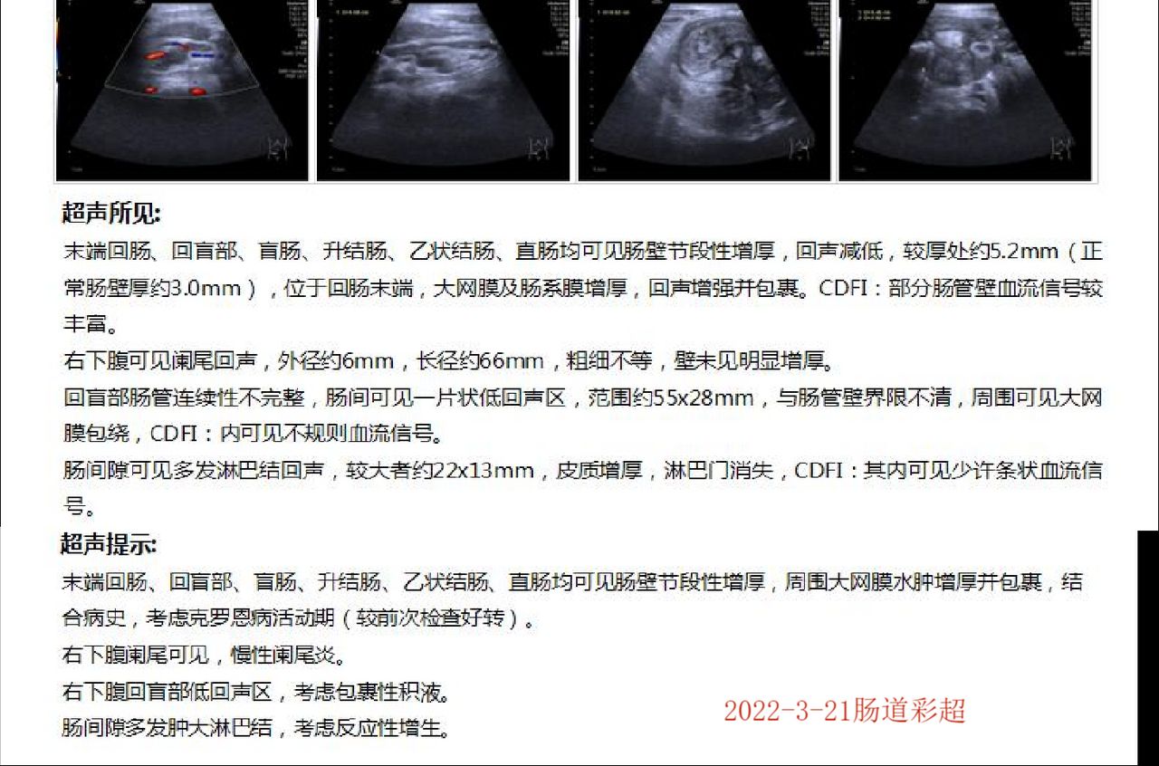回肠克罗恩病可用阿达木治疗吗,克罗恩有肠瘘怎么动手术