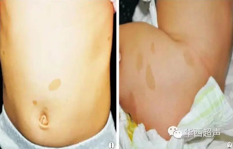 22岁女孩瘫痪在床与上千肿瘤对抗,22岁女子身体上千颗肿瘤