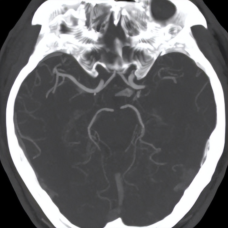 通窍活血汤方剂配伍,中成药溶栓化瘀的治疗效果及疗程