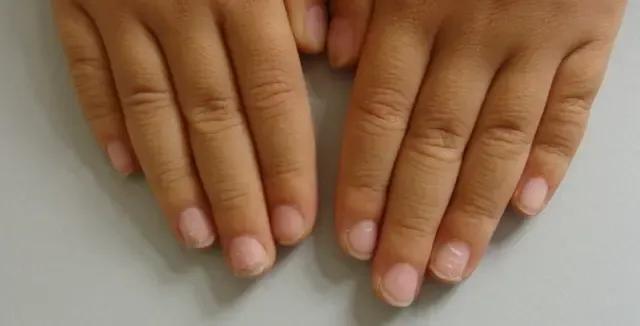 孩子的指甲壳上有白点,小孩指甲里有白点是缺乏维生素吗