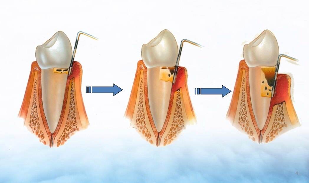 备孕会不会出现牙疼,牙出现大洞牙疼怎么办
