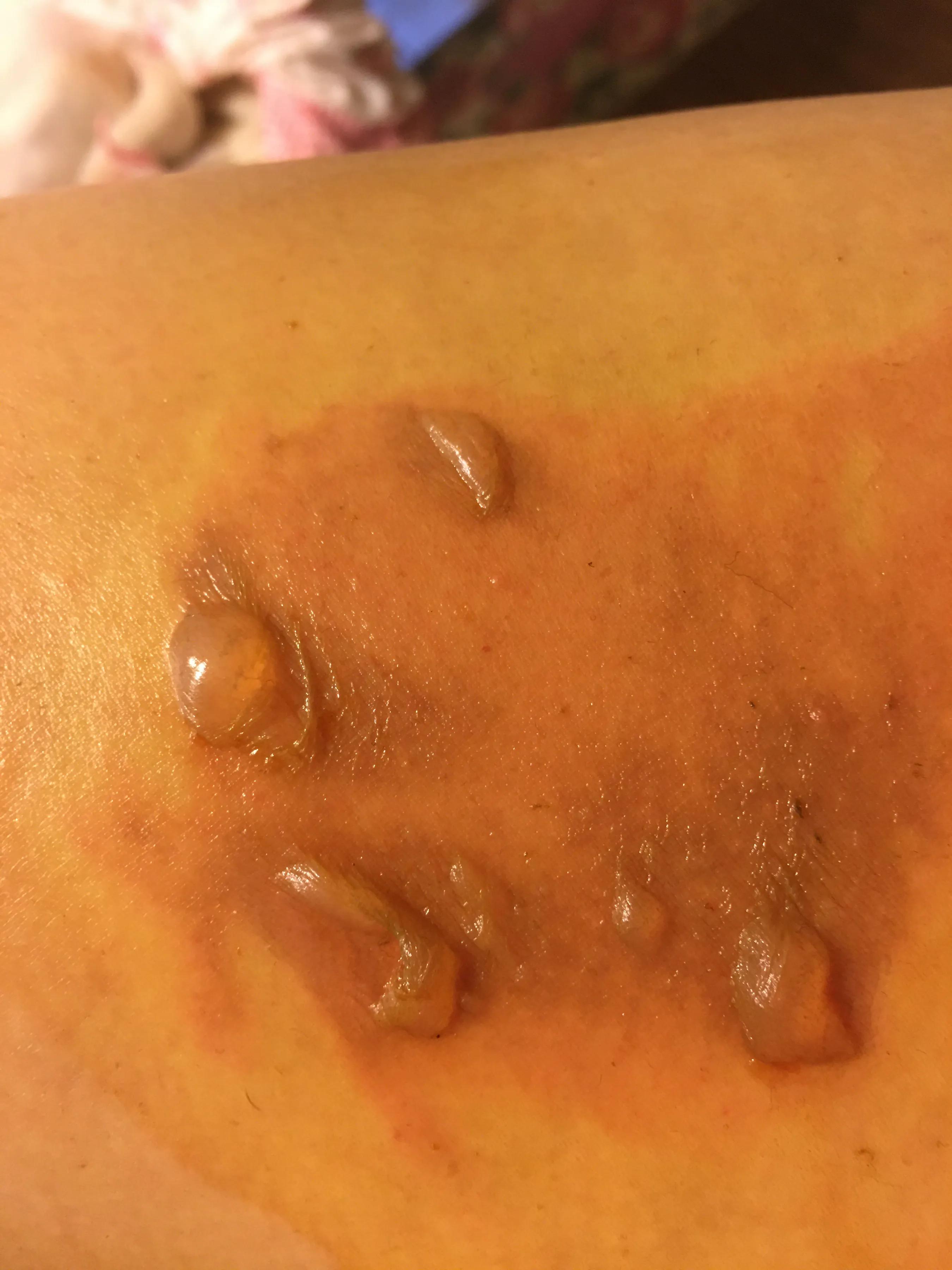 烫伤后续治疗费用怎么赔,烫伤的处理以及案例分析