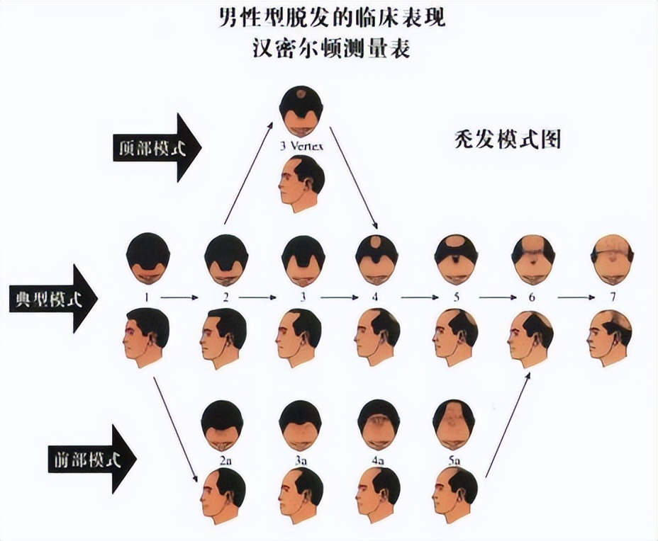 脱发的原因及防脱发小妙招,脱发原因及解决方法预防脱发