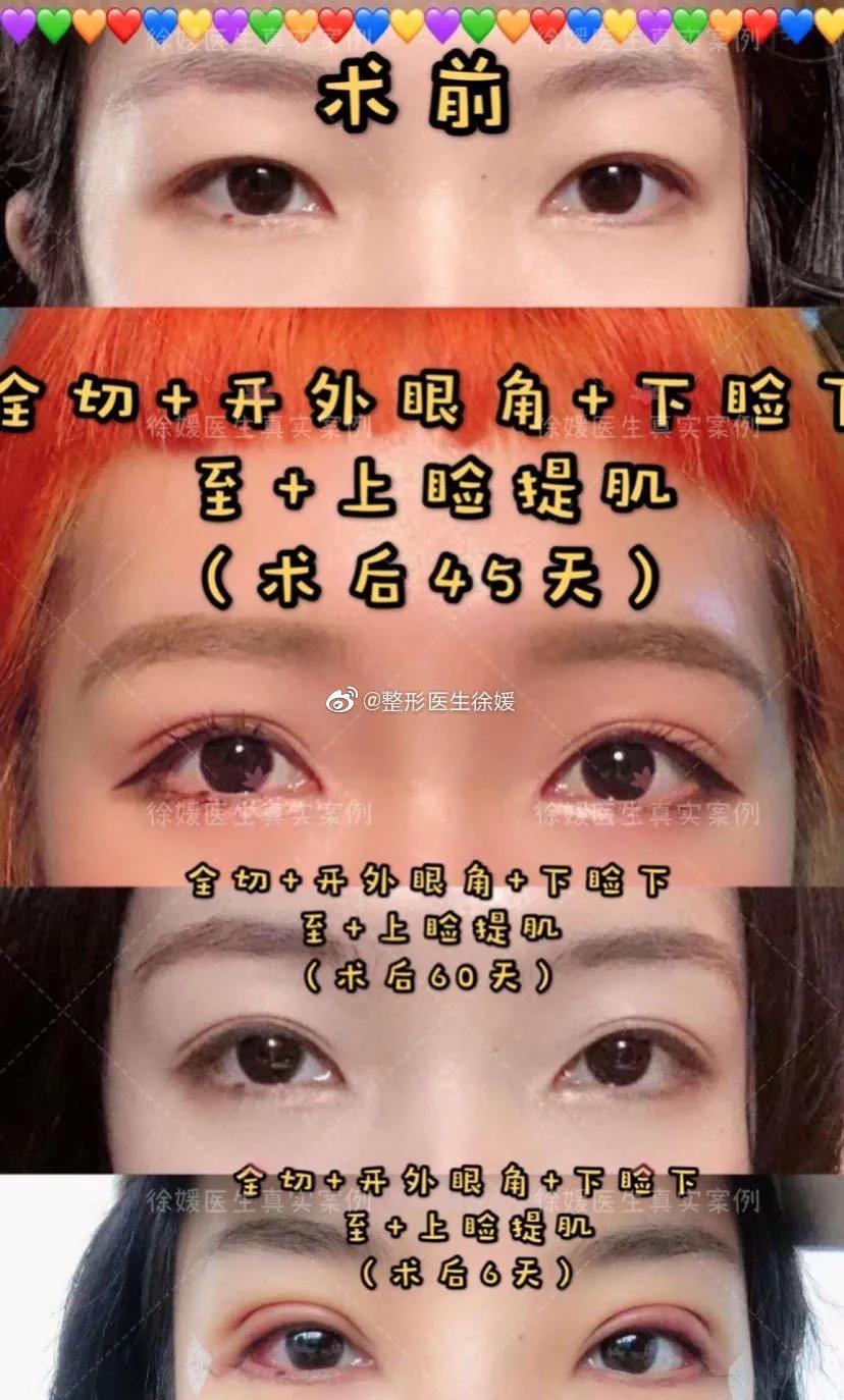 外眼角手术前后对比,做外眼角手术的优势有哪些