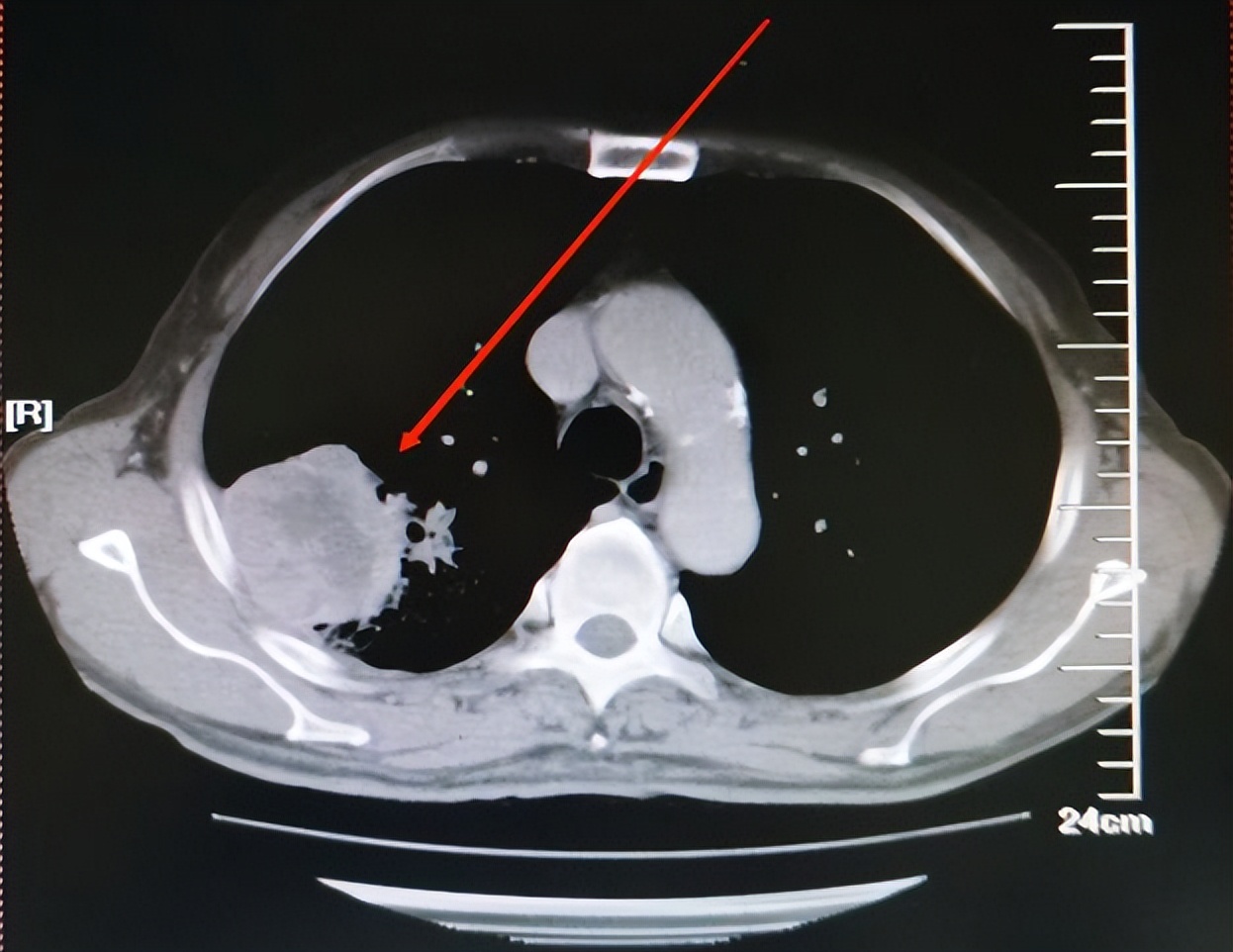 肺癌化疗后又恶化,肺癌化疗后明显缩小会复发吗