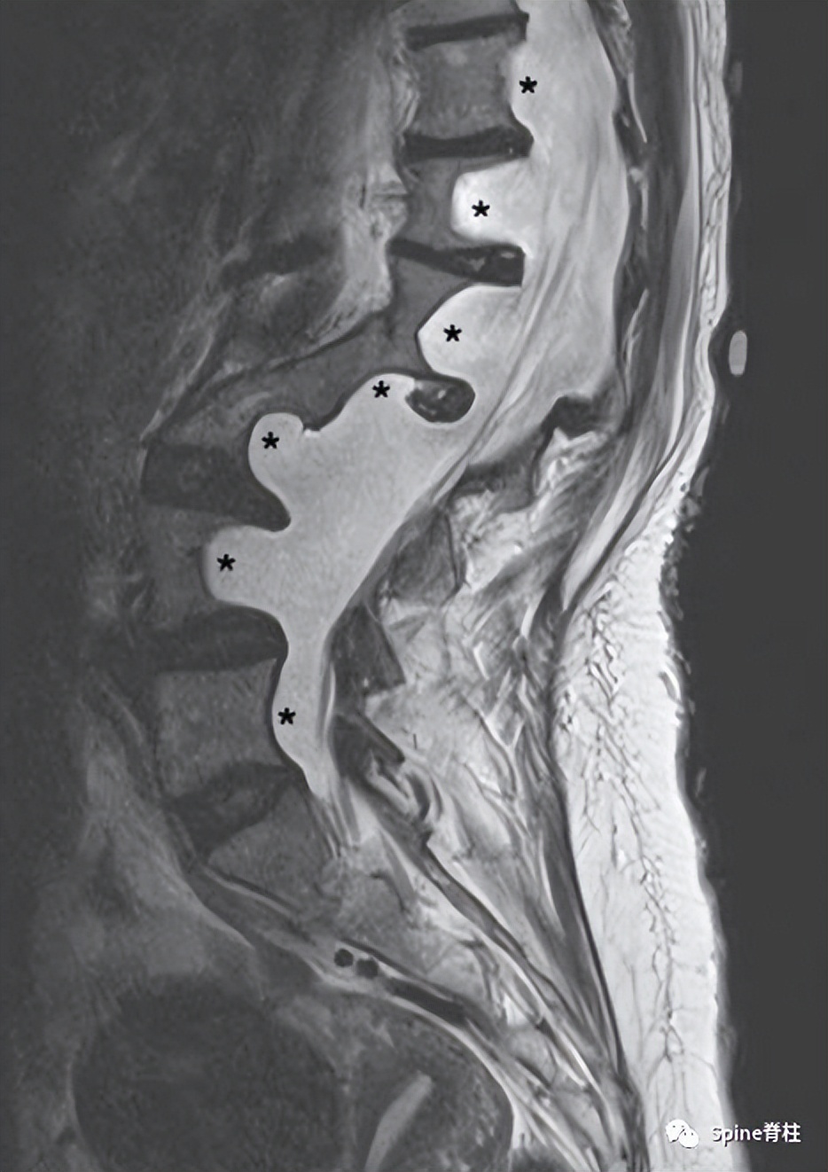 硬膜囊扩张是什么意思,硬膜囊扩张压迫神经