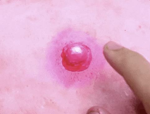 成年人崩溃的一瞬间就是反复长痘...