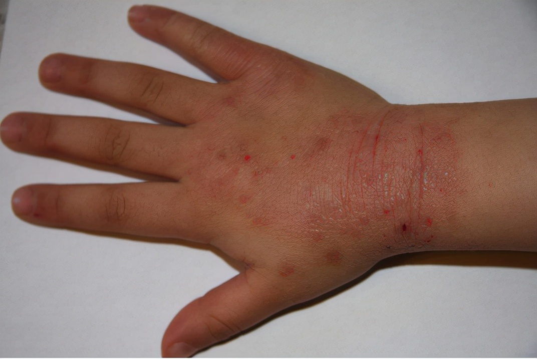 中药过敏皮疹如何止痒,中医治疗皮疹止痒的最佳方法