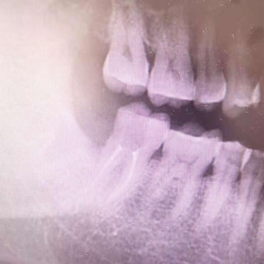 牙髓炎疼的快速止痛方法,牙髓炎疼痛怎么办速效方法
