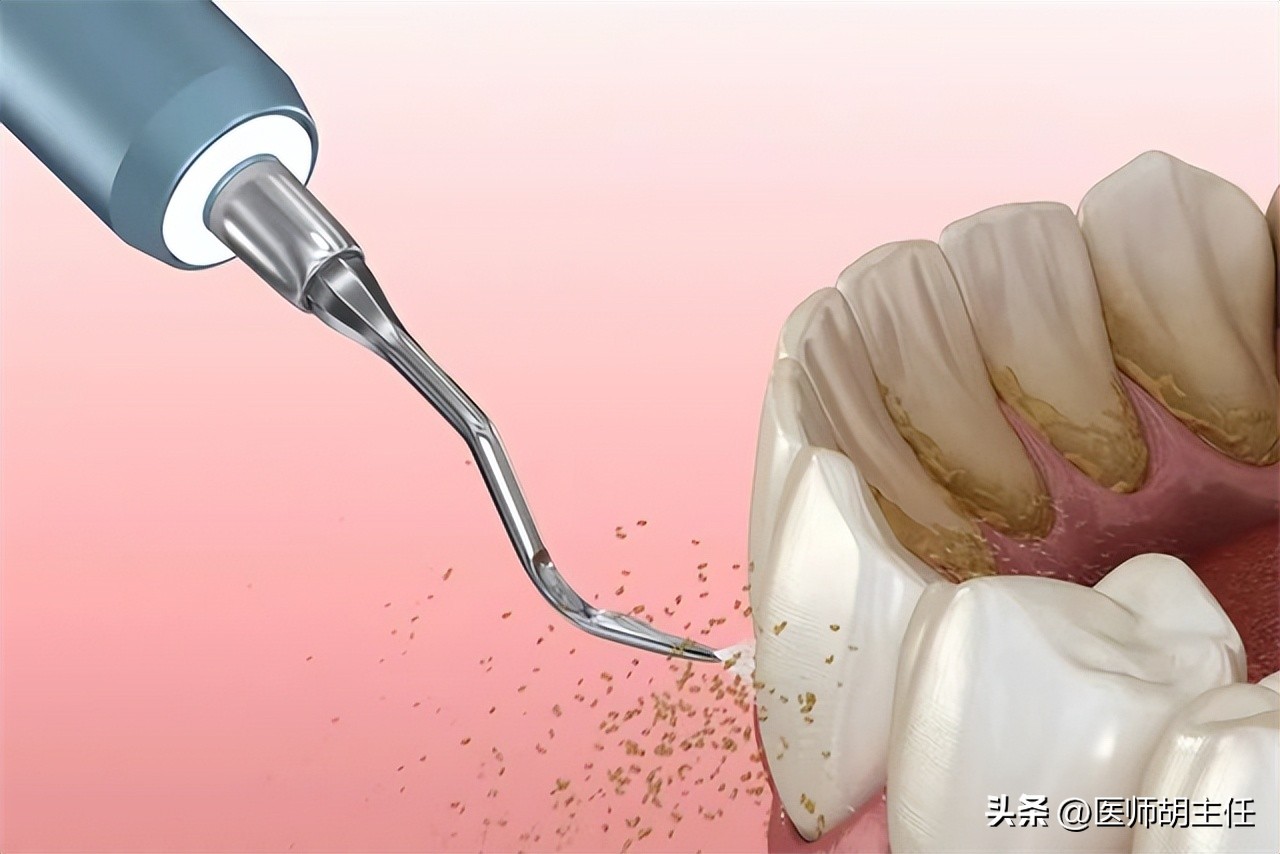 清理牙缝牙结石最有效方法,如何清除牙缝里的牙结石
