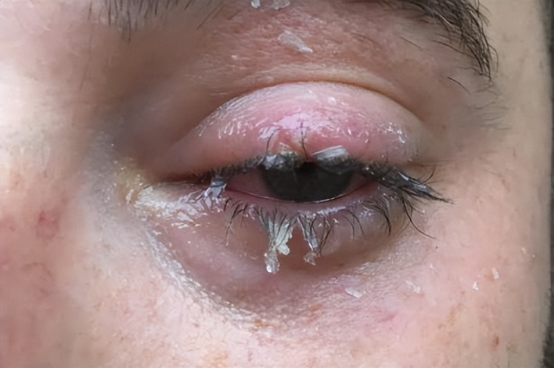 502不小心溅到眼睛里了怎么办,502溅了一点点进眼睛里了怎么办