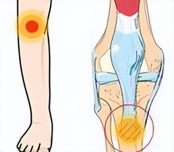 小腿变弯曲是缺钙了吗,小腿变弯处理方法