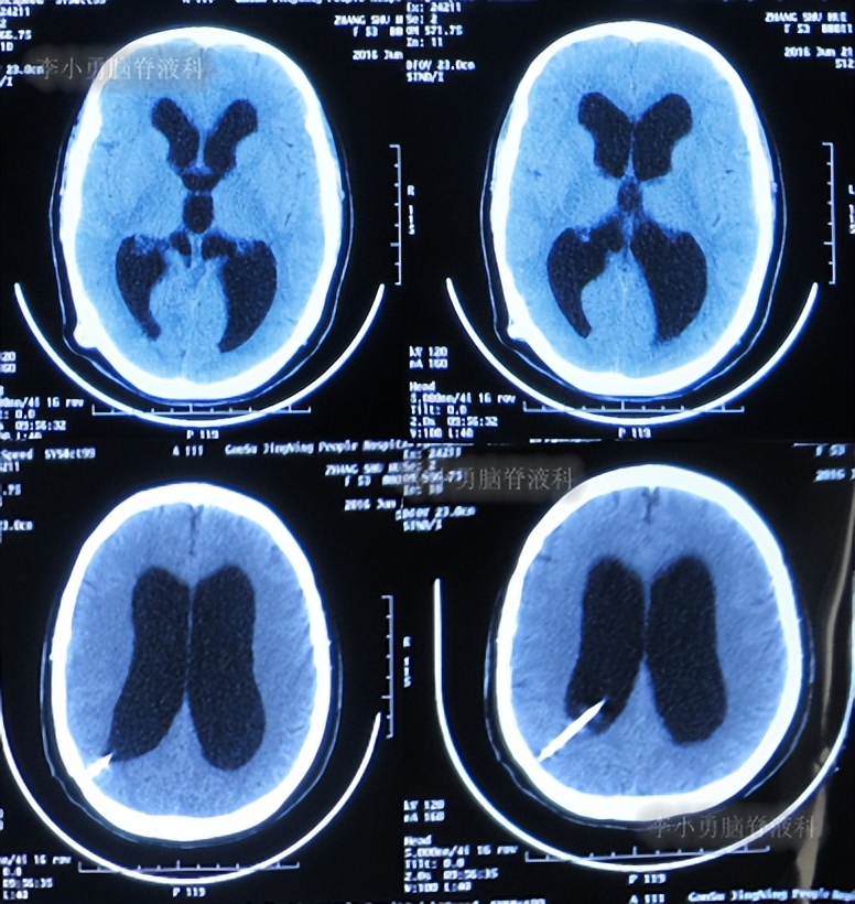 脑积水手术后4天还呕吐怎么回事,脑积水分流术后一直腹部疼痛