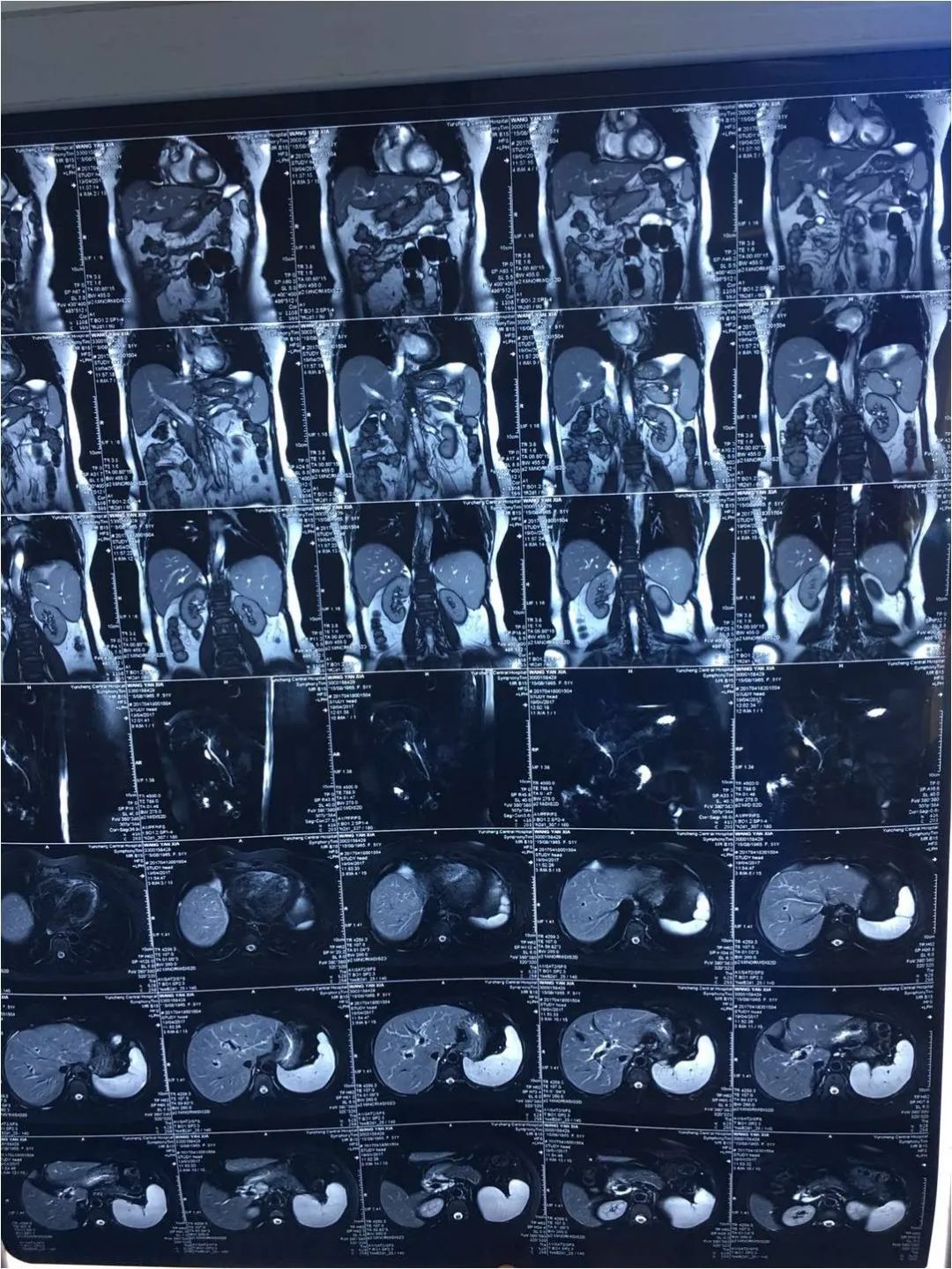 黄疸胆红素反复升高怎么回事,黄疸会导致谷草转氨酶升高吗