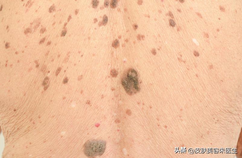 长凸出来的老年斑会是得了癌症吗,40岁老年斑增多是癌症的征兆
