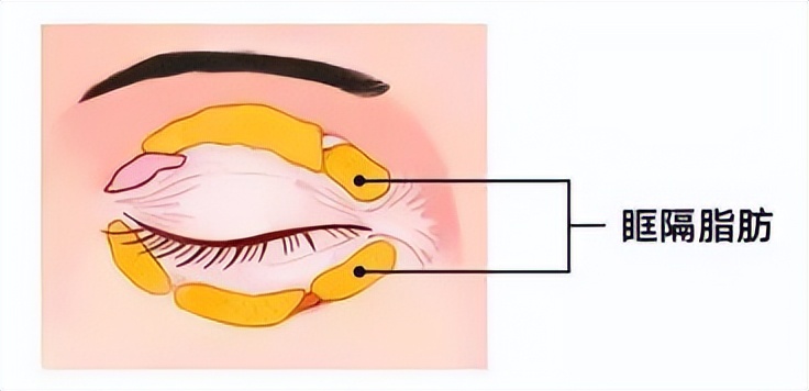眼窝凹陷自我矫正训练,眼窝凹陷眼珠凸出训练
