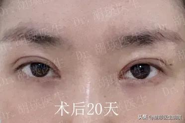 为什么很多人喜欢双眼皮,为什么男生喜欢双眼皮的女孩