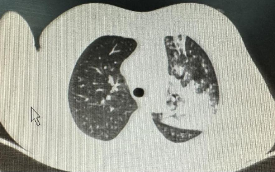 小孩咳嗽发烧前面高热后面低热,孩子反复高热咳嗽是什么原因