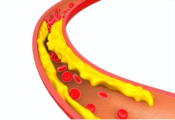 颈动脉斑块如何治疗效果好,颈动脉斑块如何治疗三分钟说清楚