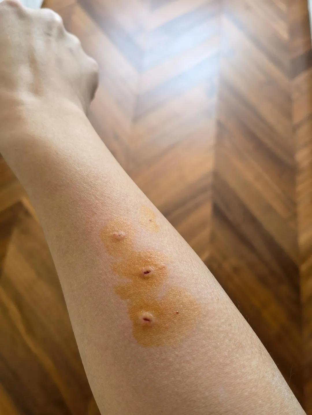 打狂犬疫苗喝咖啡了有什么后果,打狂犬疫苗喝咖啡了怎么办