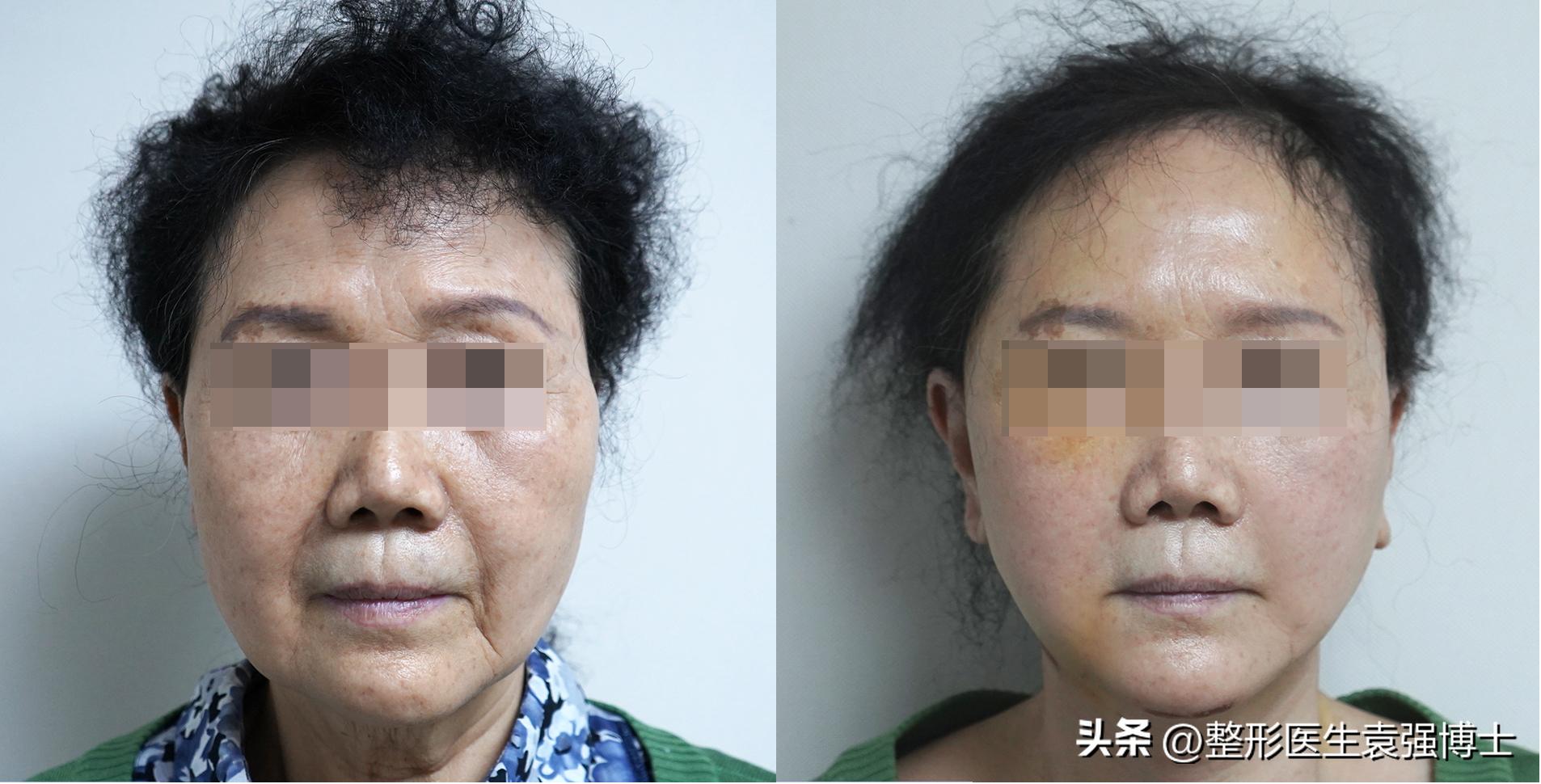 71岁不怕切口长，直接做了大拉皮，第7天拍照看，没敢认啊