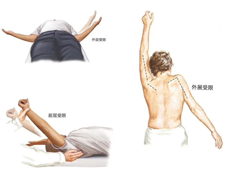 秦皇岛军工医院运动医学门诊医生带您了解“肩周炎”