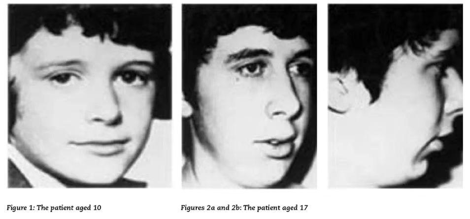 腺样体肥大造成嘴唇变厚会变丑吗,用嘴呼吸变丑还是腺样体肥大变丑