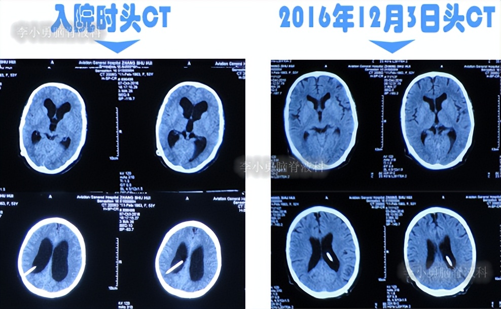 脑积水手术后4天还呕吐怎么回事,脑积水分流术后一直腹部疼痛
