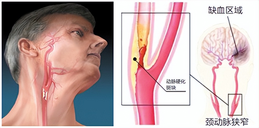 颈椎病会引起疾病怎么治疗,颈椎病导致心脑血管疾病