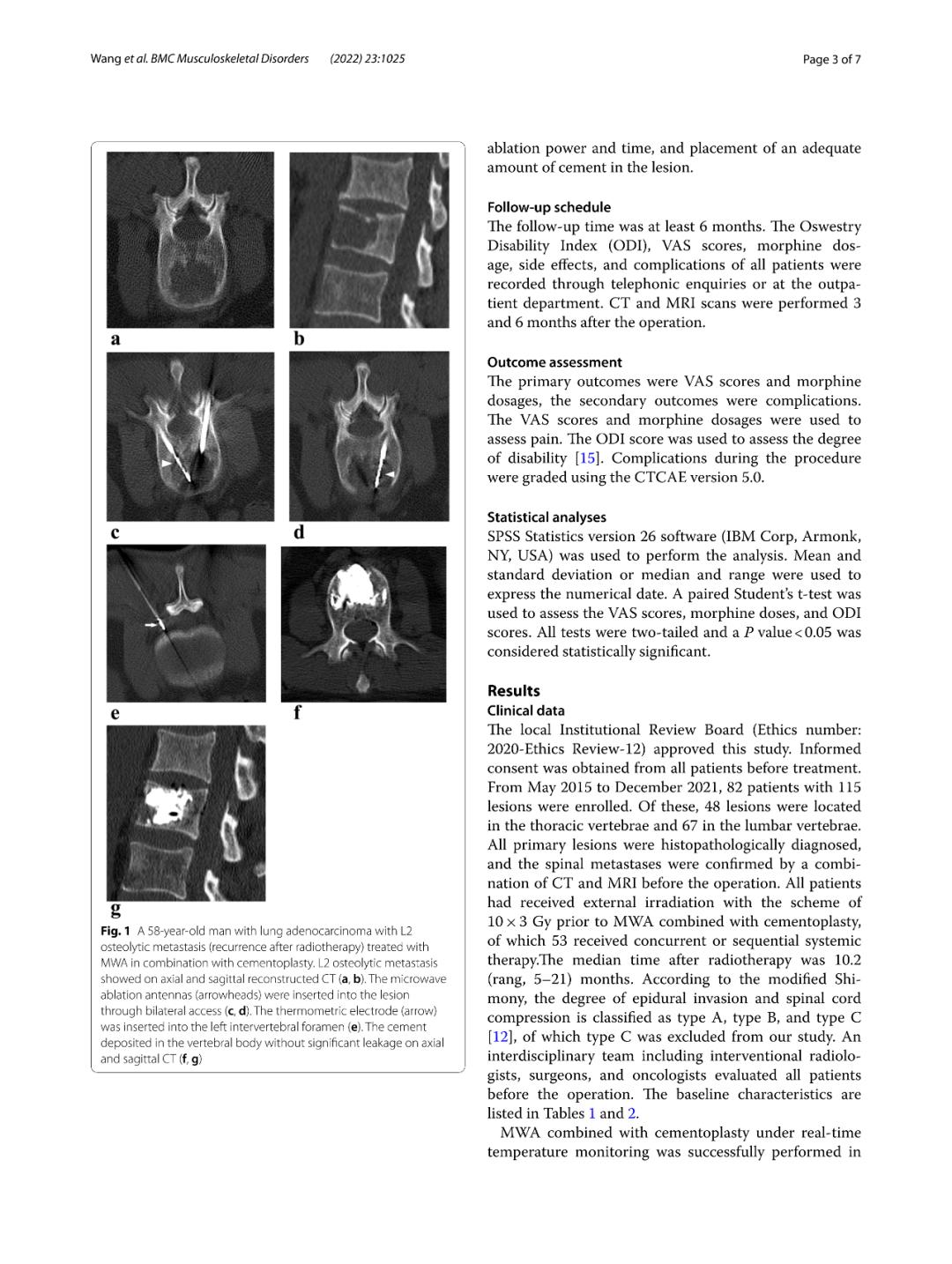 微波消融联合温度监测骨水泥成形术治疗放疗后复发性脊柱转移瘤