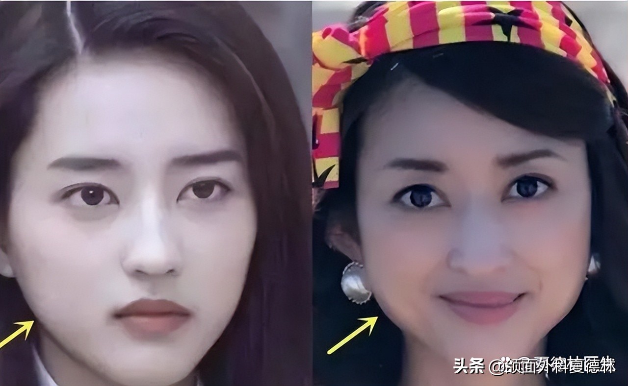 如何预防脸发腮,什么样的脸容易发腮