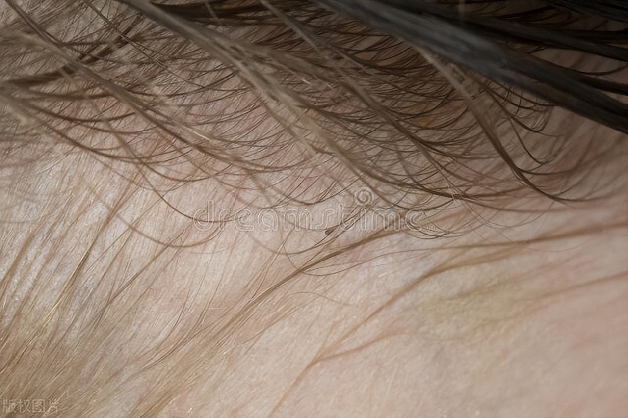 男性下身长阴虱多久生虫卵,男子阴虱