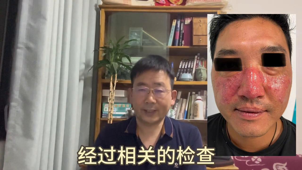 民间治愈玫瑰痤疮的偏方,治玫瑰痤疮的特效药