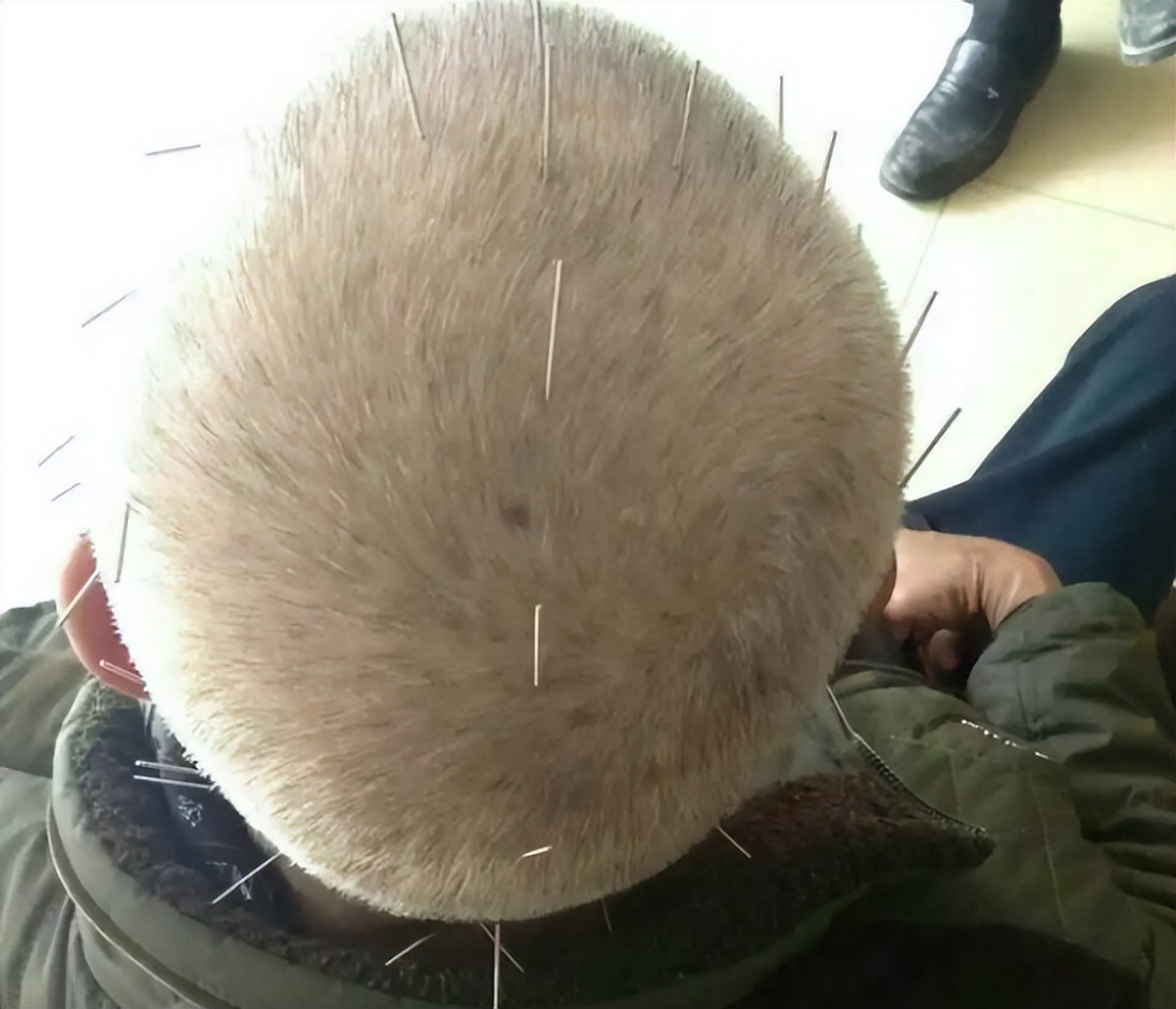 中风并发症会增加病死率，中医特色疗法针灸治疗效果如何？