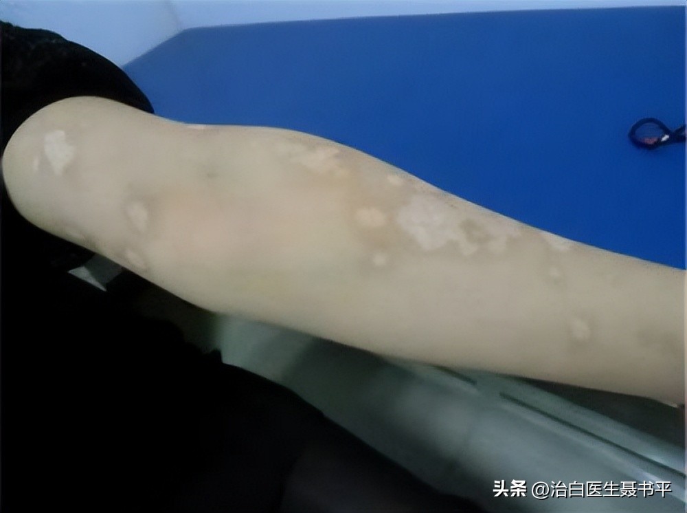 白癜风停止扩散纹身遮盖怎么样,女孩白癜风治好会再复发吗