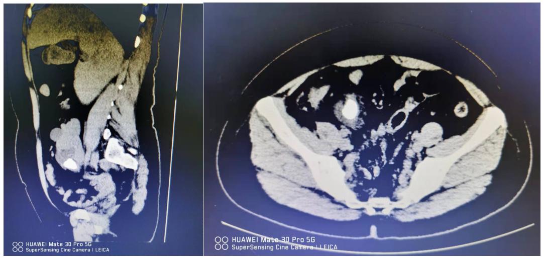 右肾部有1.3厘米的结石需要治疗吗,右肾1.6厘米的结石需要碎石吗